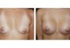 Breast Fat Transfer Case Study
